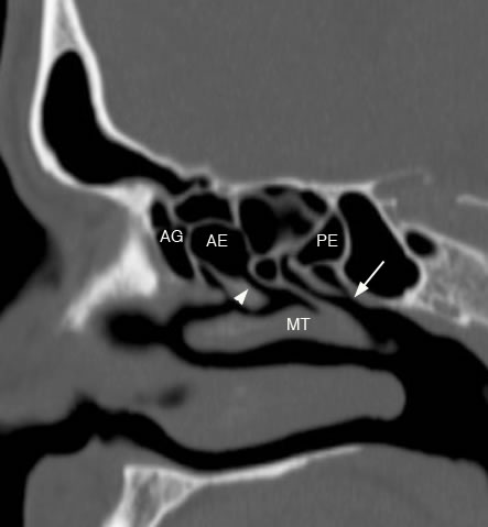 sagittal ethmoid sinus