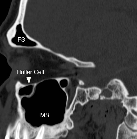 sagittal ethmoid sinus