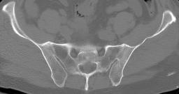 Ankylosing spondylitis SI joint CT3: Ankylosing spondylitis SI joint CT