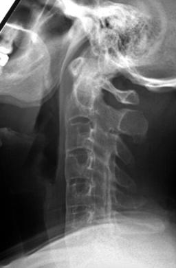 Ankylosing spondylitis C-spine: Ankylosing spondylitis C-spine