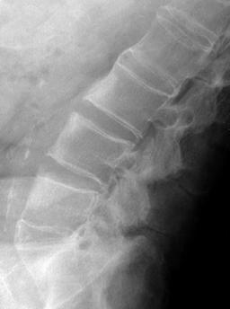 Ankylosing spondylitis shiny corners: Ankylosing spondylitis shiny corners