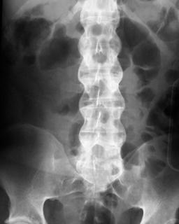 Ankylosing spondylitis lumbosacral AP: Ankylosing spondylitis lumbosacral AP