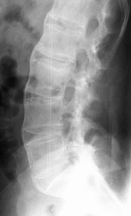 Ankylosing spondylitis lumbosacral lateral: Ankylosing spondylitis lumbosacral lateral