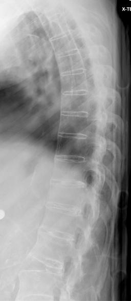 ankylosing spondylitis pseudoarthrosis1: ankylosing spondylitis pseudoarthrosis