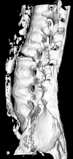 Ankylosing spondylitis pseudoarthrosis2: ankylosing spondylitis pseudoarthrosis