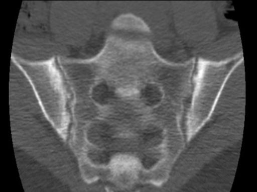 Ankylosing spondylitis SI joint CT2: Ankylosing spondylitis SI joint CT