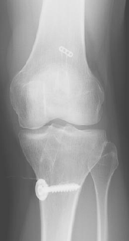 ACL hamstring AP: 