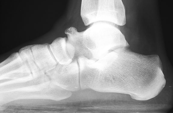 calcaneal beak fracture