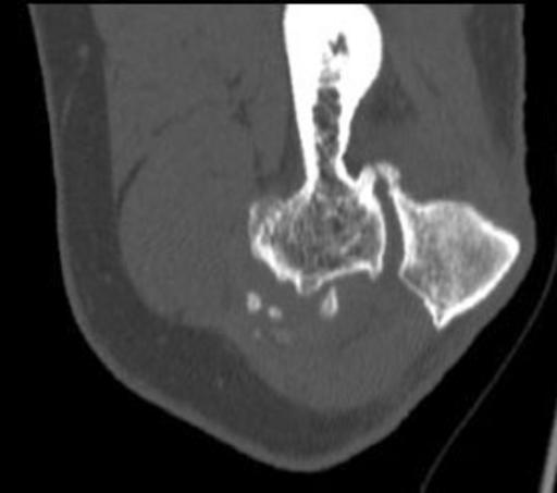 intraarticular bodies CT: 