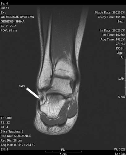 Cafib: Calcaneofibular ligament