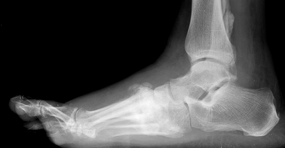 charcot foot images