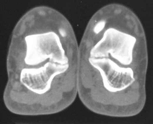 CT bilat talocalc coalition: 