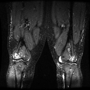 Sickle Cell: femur necrosis and marrow hyperplasia 3: The patient is a black female with sickle cell disease. Note the extensive red marrow reconversion, AVN right hip and both knees and bone infarcts in both femurs.