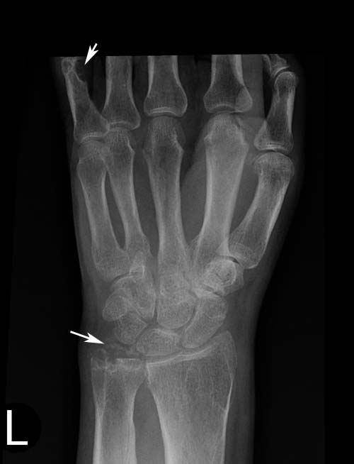 of the tophus on the ulnar