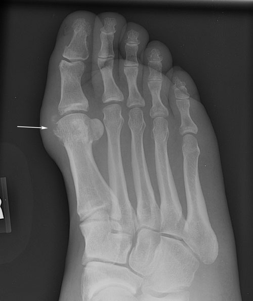 tophus xray