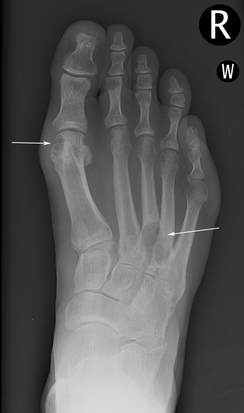 Gout - multiple erosions: 