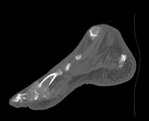 Gout - sagittal CT: 