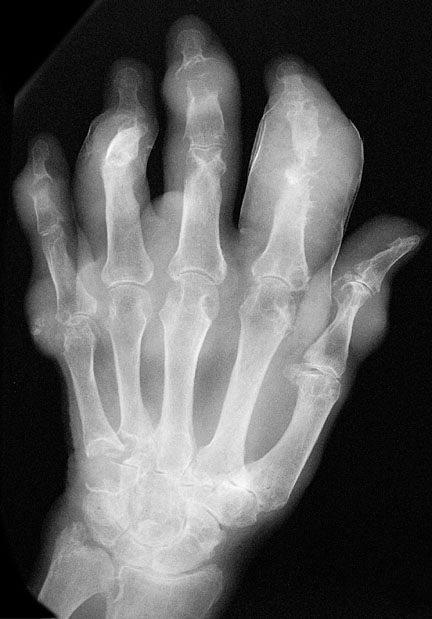 tophus xray