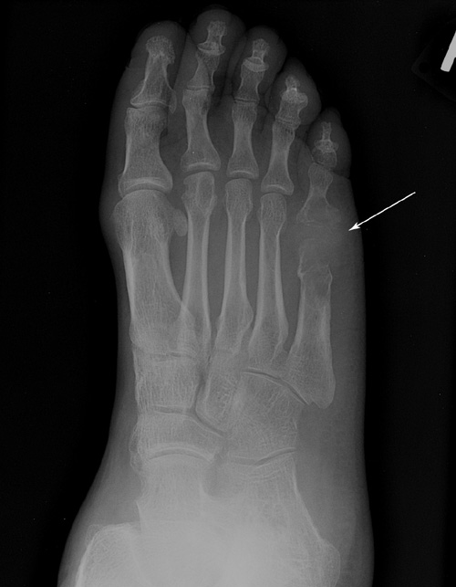 Gout Tophaceous