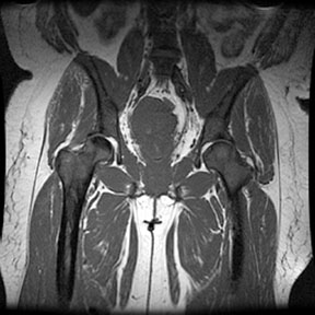 Sickle Cell: femur necrosis and marrow hyperplasia 4: The patient is a black female with sickle cell disease. Note the extensive red marrow reconversion, AVN right hip and both knees and bone infarcts in both femurs.