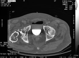 Hips axial CT: 