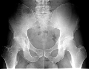 Bilateral Hips: 