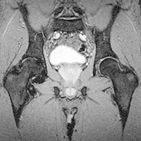 Hips coronal MRI GRE: 