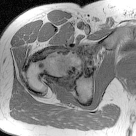 Hip axial T1: 