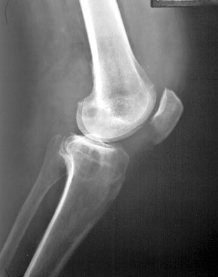 PVNS Knee: 