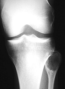 GiantCell: AP radiograph of the knee