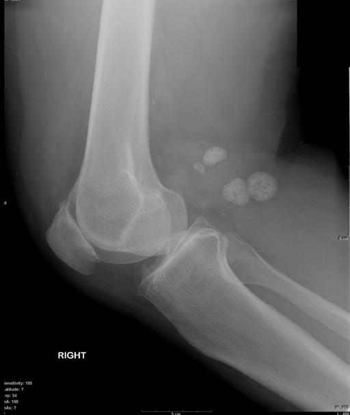 Physical Therapy For Loose Body In Knee - Caulder-mezquita