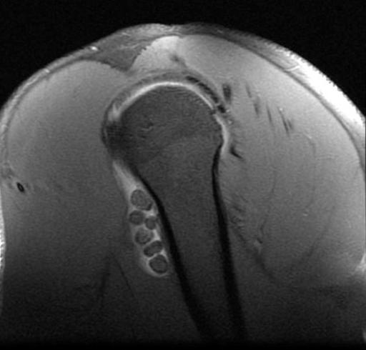 intraarticulaire lichaampjes MR: