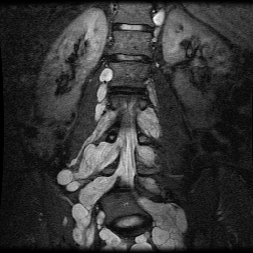 Uw Msk Resident Projects Neurofibromatosis Type 1 2992