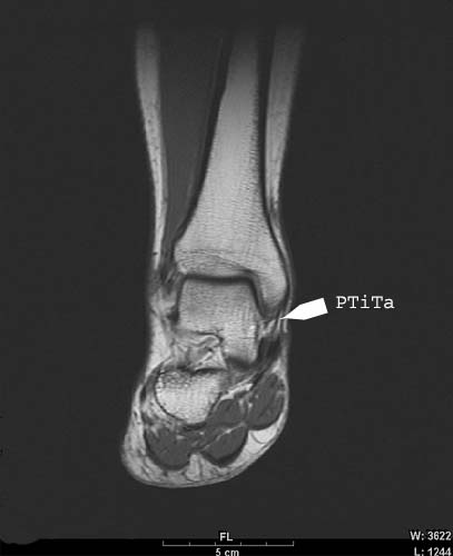 PTiTa: Posterior Tibiotalar Ligament