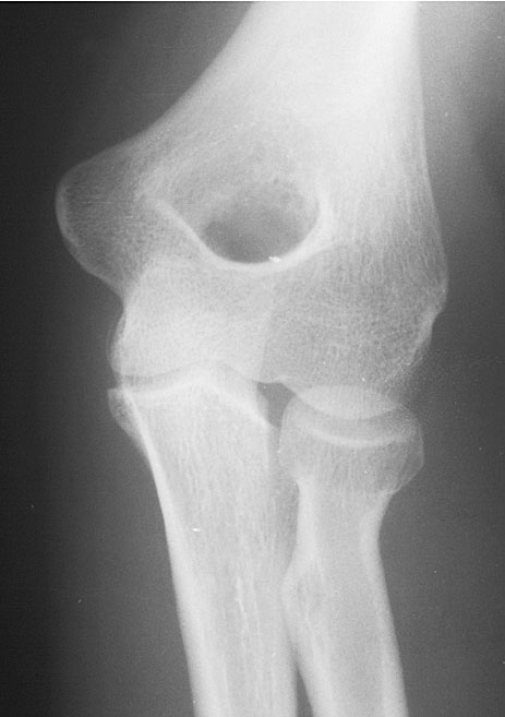 Radial Condyle