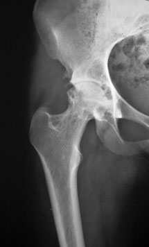 Right Hip and acetabulum: 