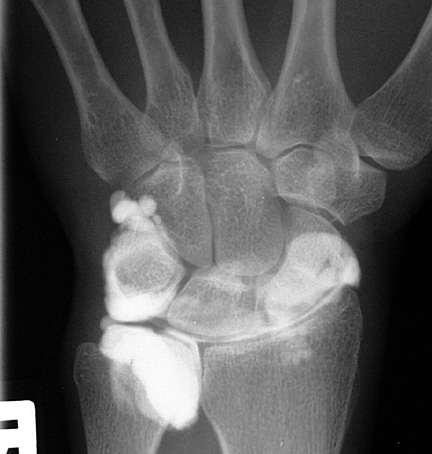 TFCC tear conventional arthrogram: 