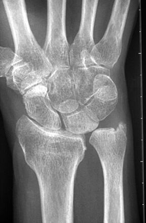 Ulnar impaction syndrome: 