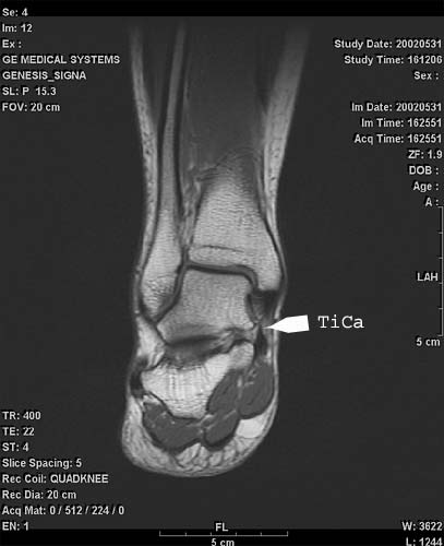 TiCa1: <P><SPAN style="FONT-SIZE: 12pt; FONT-FAMILY: 'Times New Roman'; mso-fareast-font-family: 'Times New Roman'; mso-ansi-language: EN-US; mso-fareast-language: EN-US; mso-bidi-language: AR-SA">Tibiocalcanean ligament 1</SPAN></P>