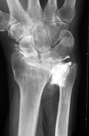 Ulnar impaction arthrogram with TFCC tear: 