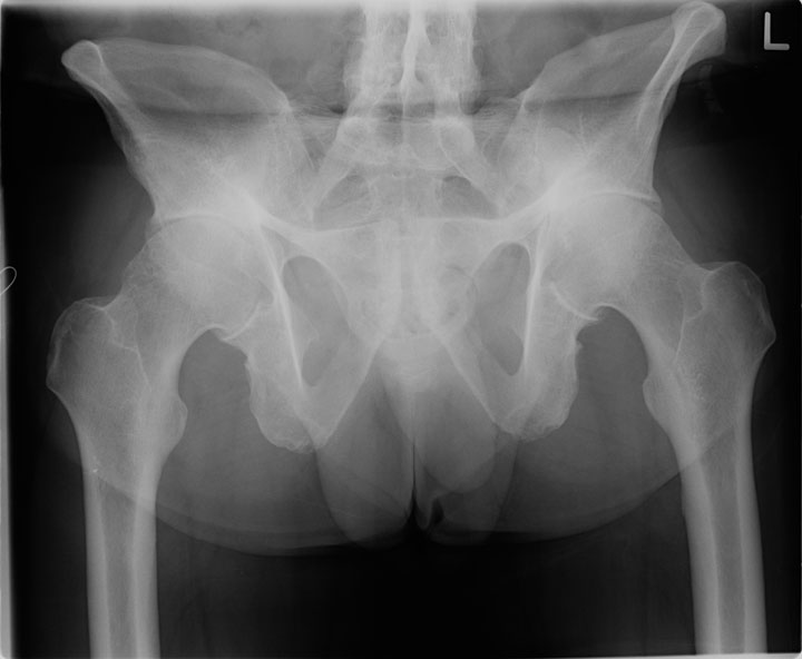 cervical ankylosing spondylitis x ray