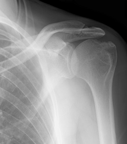 Ankylosing spondylitis shoulder 2: 