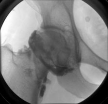 Arthrogram hip: 