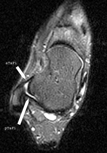 icd 10 code for right ankle anterior talofibular ligament tear