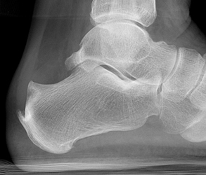 Posterior Calcaneal Spur