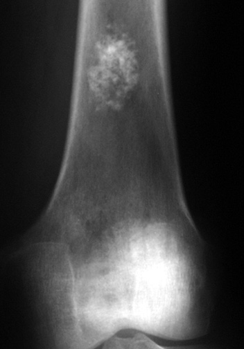 Enchondroma - femur: Enchondroma in the distal femur.  Note the lesion is geographic with cartilagenous matrix.  There is no reaction in the adjacent bone.
