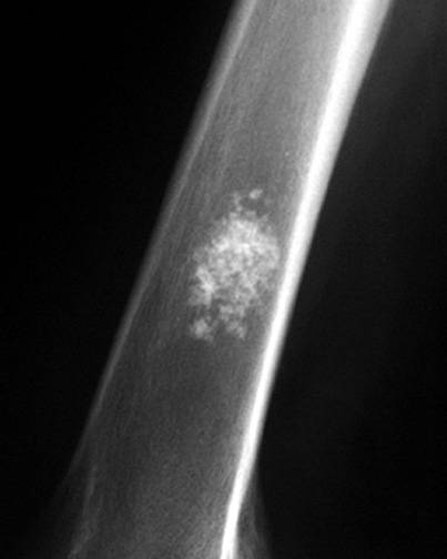 enchondroma tibia