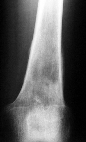 Chondrosarcoma transform 1: 