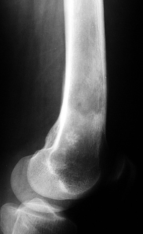 Chondrosarcoma transform 2: 