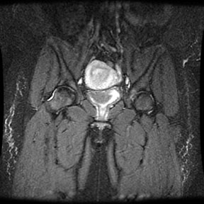 Sickle Cell: femur necrosis and marrow hyperplasia 1: <P>The patient is a black female with sickle cell disease. Note the extensive red marrow reconversion, AVN right hip and both knees and bone infarcts in both femurs.</P>